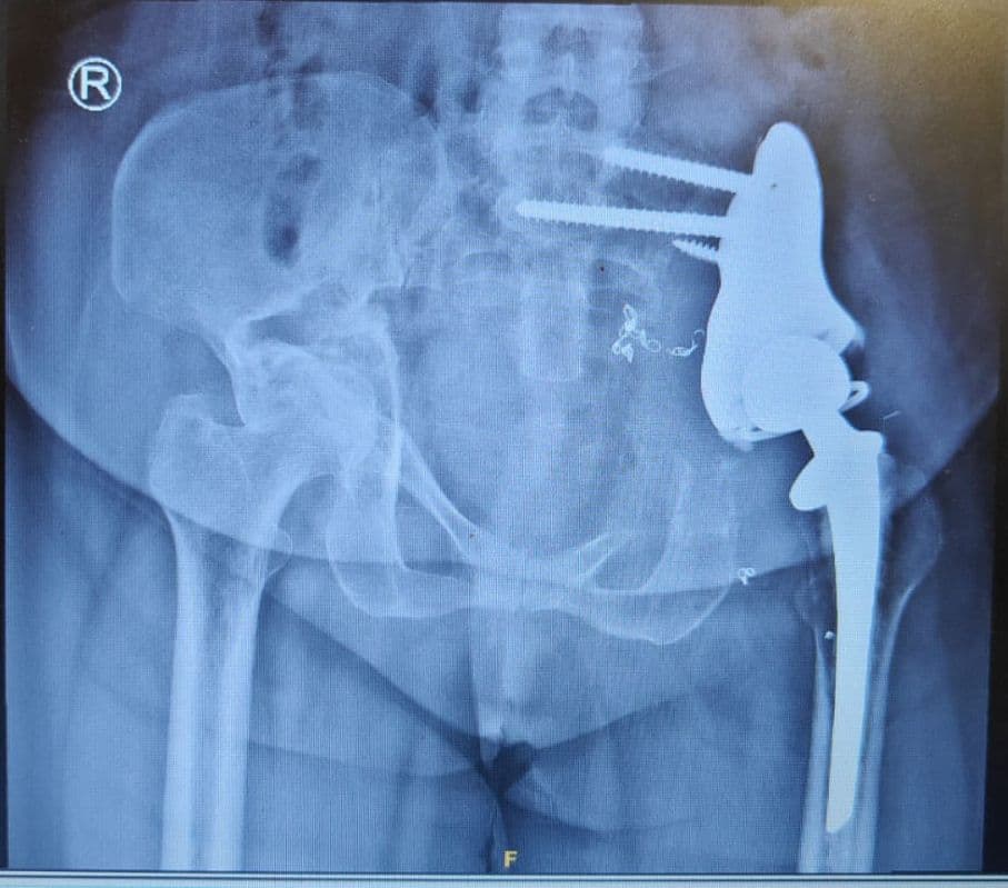 First 3D printed hemi-pelvic endoprosthetic replacement for peri-acetabular tumor in Kerala